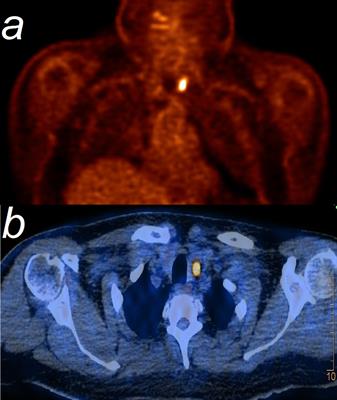 Pembrolizumab-Induced Thyroiditis Shows PD-L1Expressing Histiocytes and Infiltrating T Cells in Thyroid Tissue - A Case Report